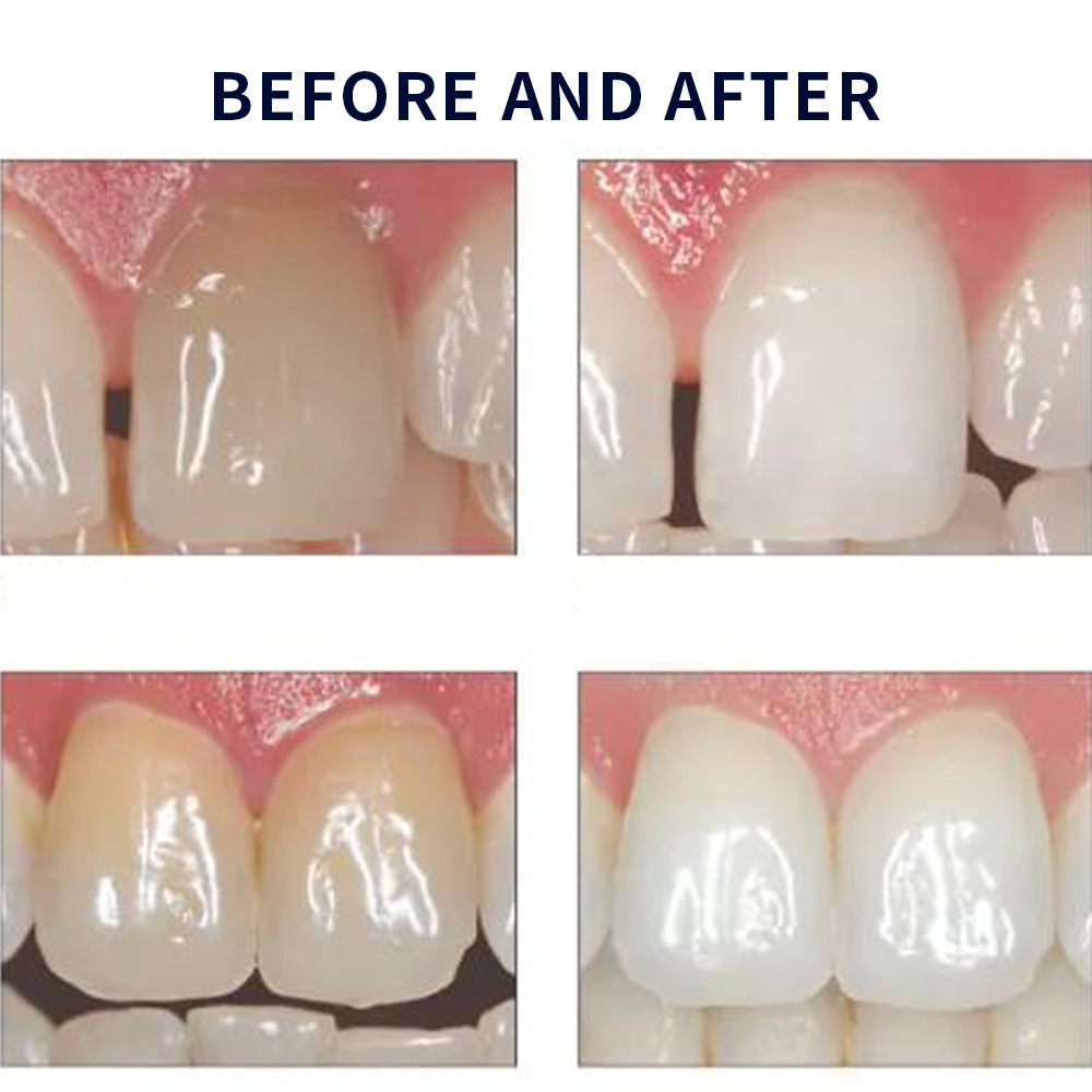Opalescencia blanqueadora 20%  - Teeth Whitening Near Me reseña y precio