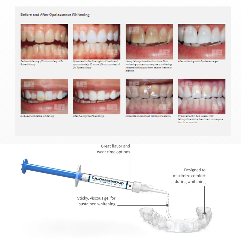 Opalescencia blanqueadora 20%  - Teeth Whitening Near Me reseña y precio