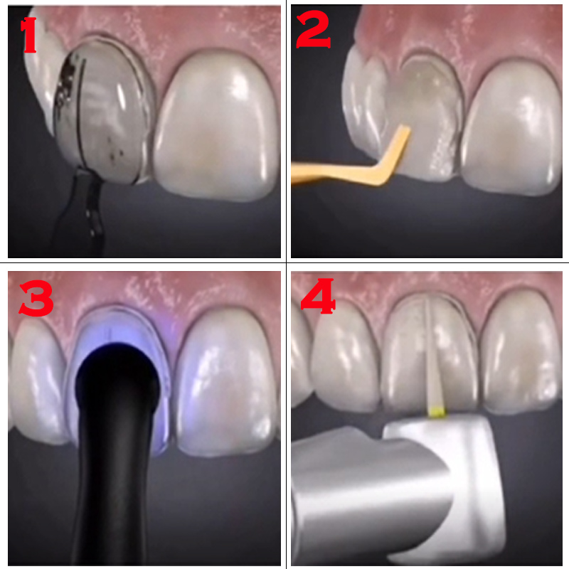 Molde dental autoclavable para - Teeth Whitening Moulds reseña y precio