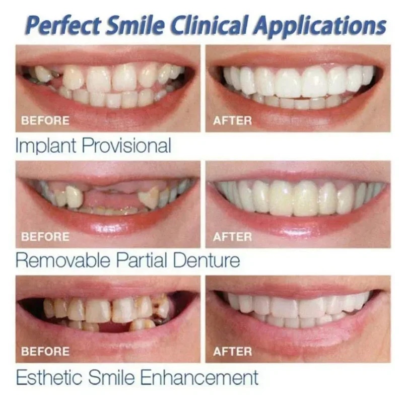 Kit de carillas dentales ajust - Teeth Whitening Kit reseña y precio